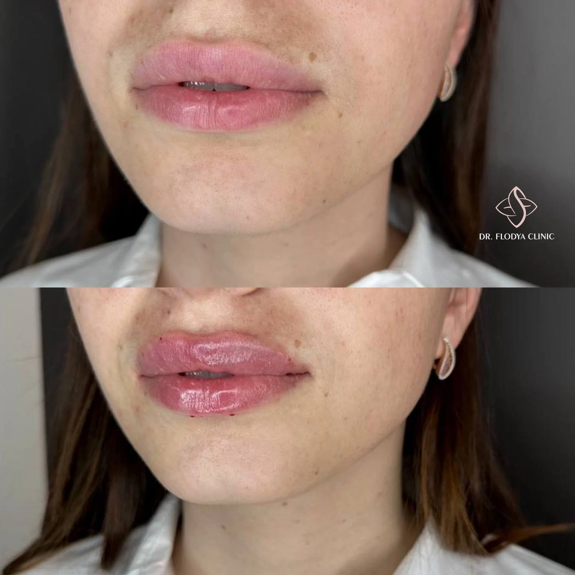 Коррекция формы губ до и после — DR. FLODYA CLINIC