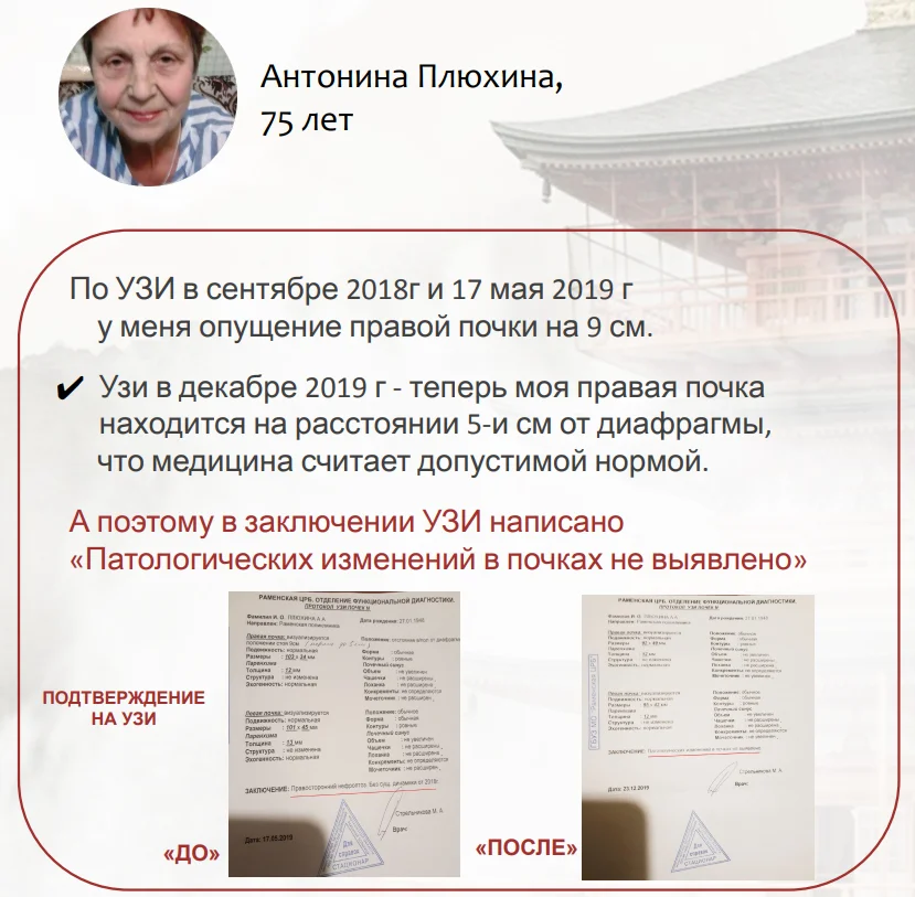 Результаты восстановления при нефроптозе