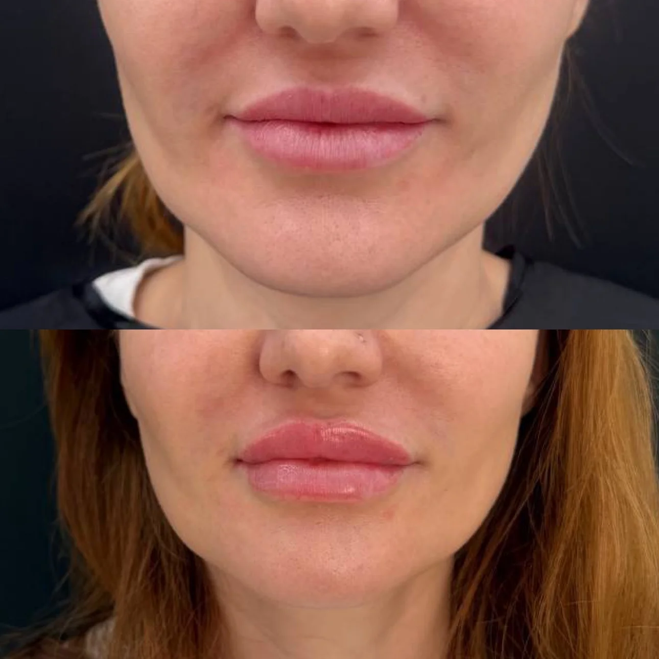 Увеличение губ до и после — Зинфира Рамазанова, DR. FLODYA CLINIC
