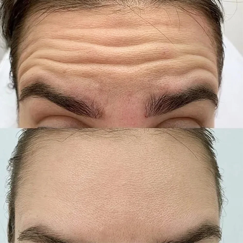 Ботулинотерапия