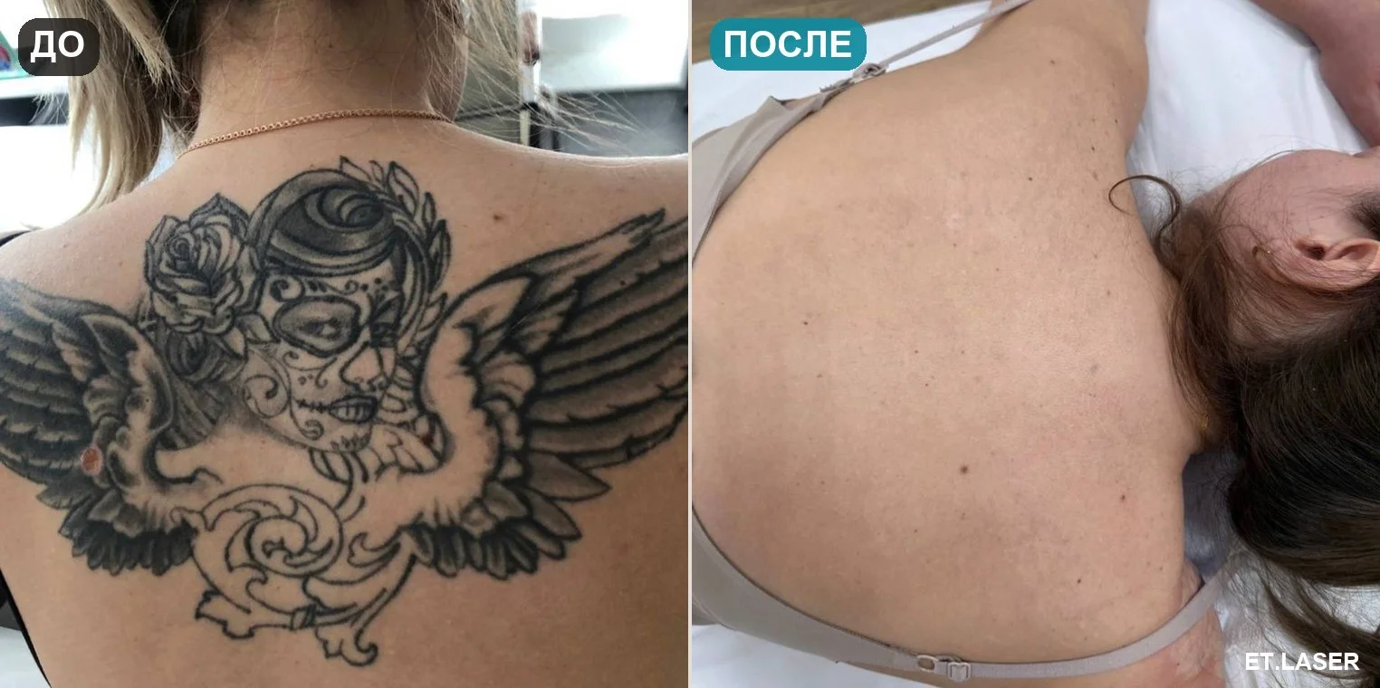 До и после: тату на спине