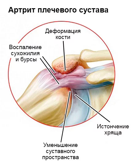 Что делать, если болит плечо?