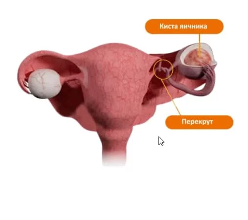 Боли в области яичников