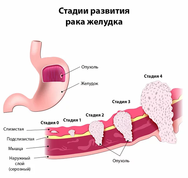 Лечение рака желудка в клинике OncoCareClinic 308