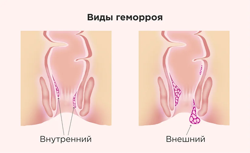 Профилактика и лечение геморроя во время беременности в Краснодаре в клинике УРО-ПРО