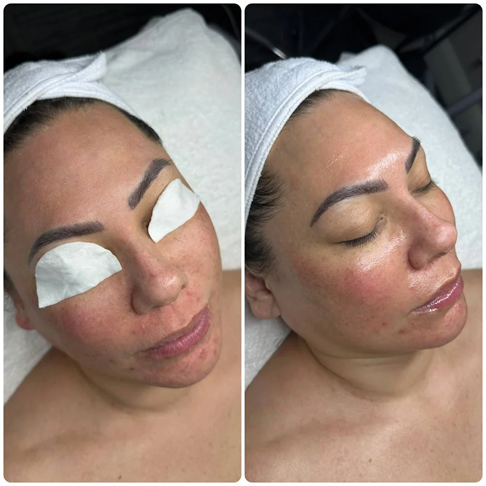 Before and after HydroDermabrasion results at Beauty Studio by Hanna in Mount Pleasant, SC