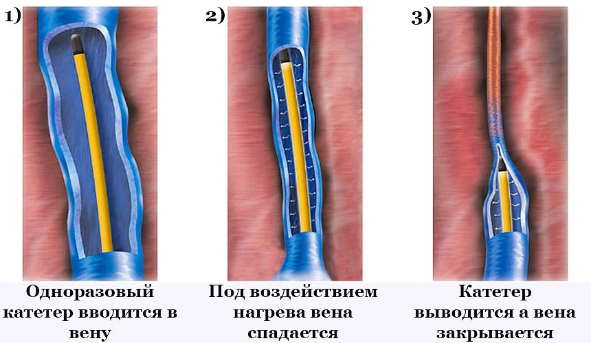 Процедура ЭВЛК
