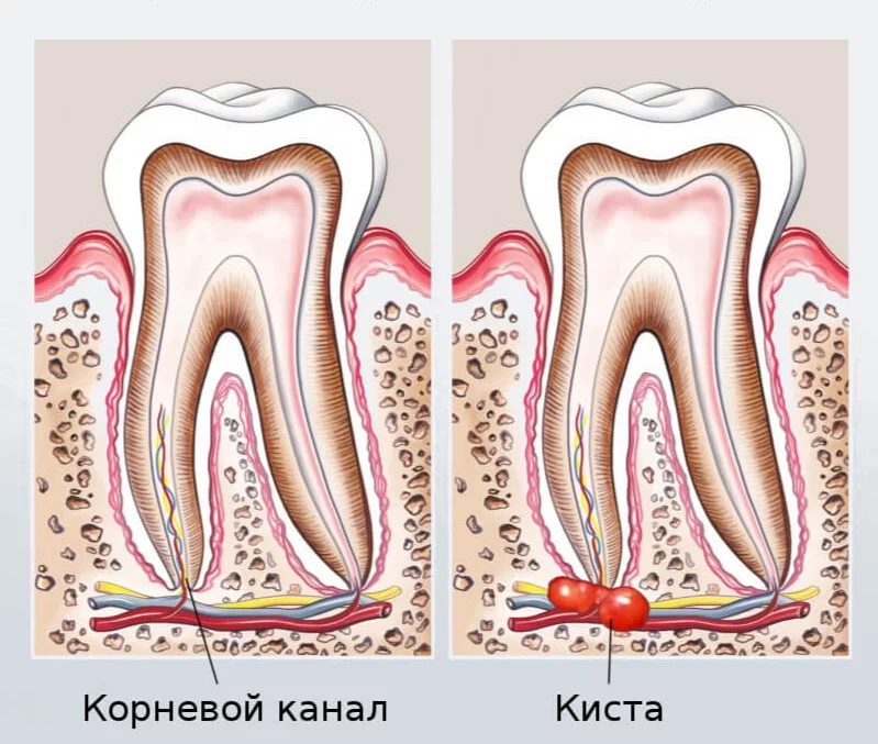 Как лечить кисту зуба - методы лечения и удаления в домашних условиях