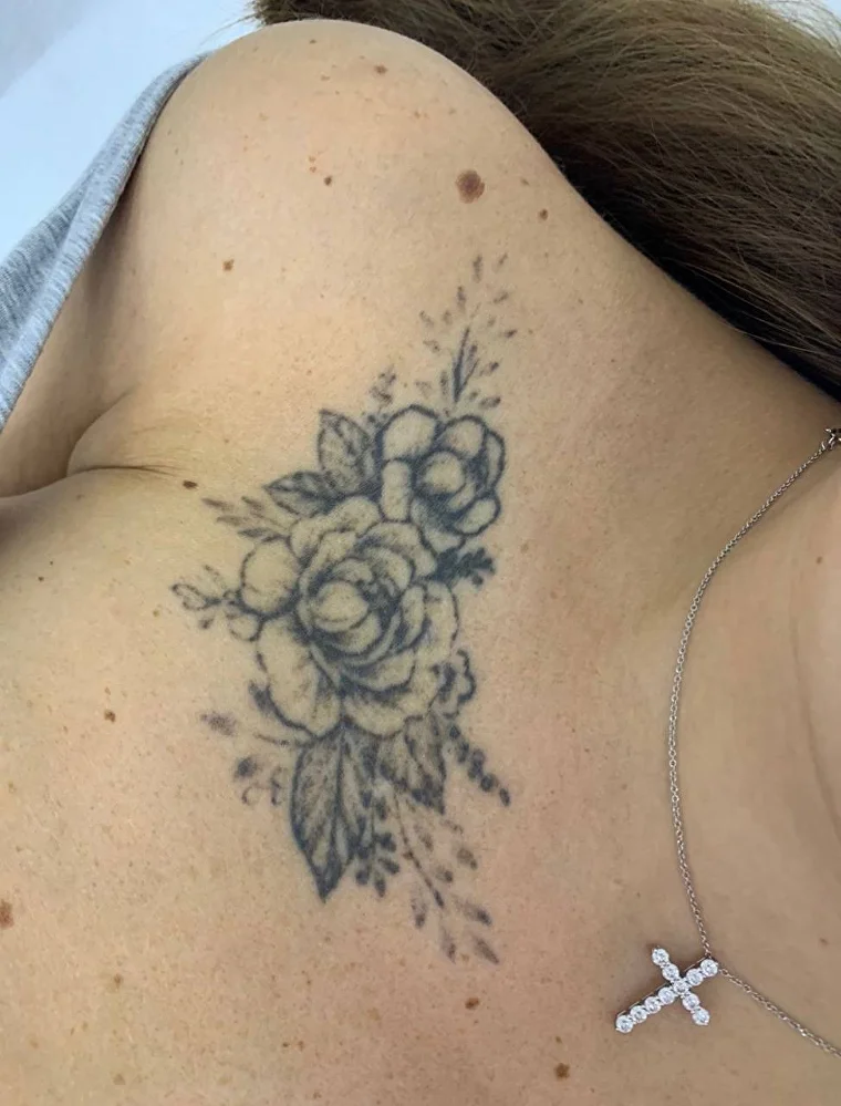 Фото до удаления тату лазером — клиника ET.LASER Москва