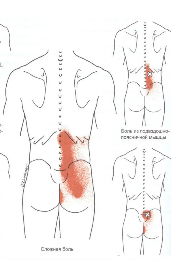 Боли в шее - причины появления, при каких заболеваниях возникает, диагностика и способы лечения