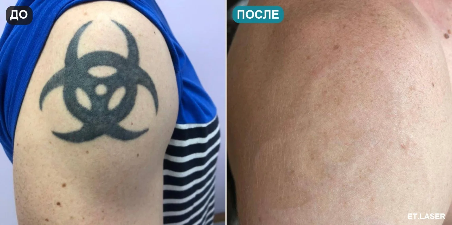 До и после: тату на плече