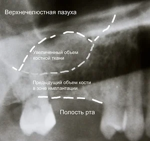 Результат костной пластики 2