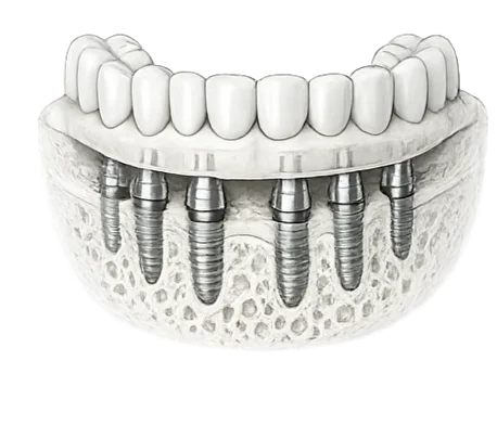 Имплантация Все на 6-ти