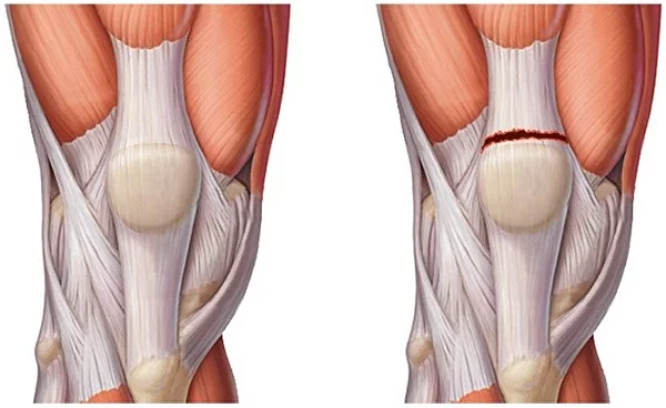 Повреждения связок локтевого сустава: причины и методы лечения