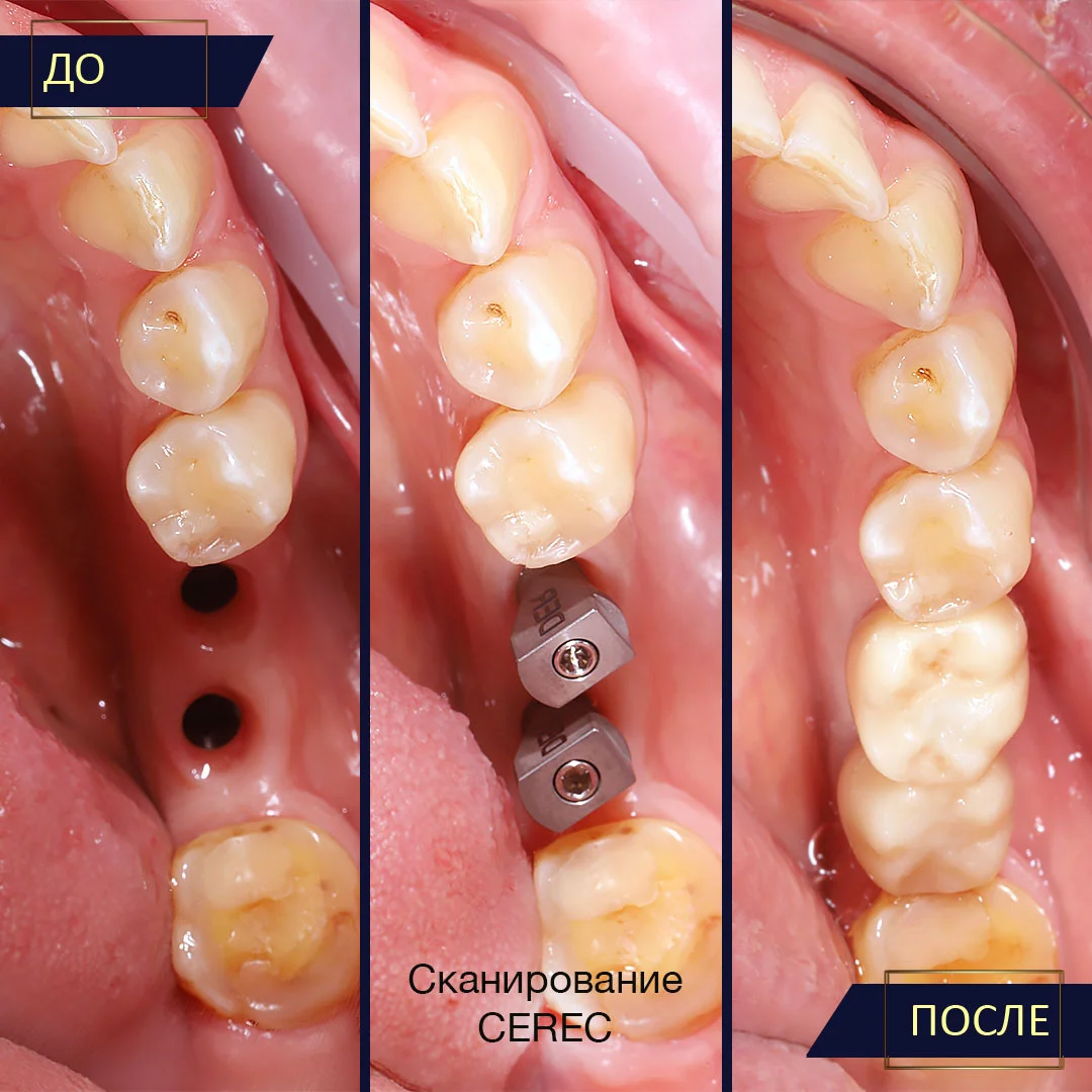 Имплантация зубов в Вологде - Стоматология ДаВинчи