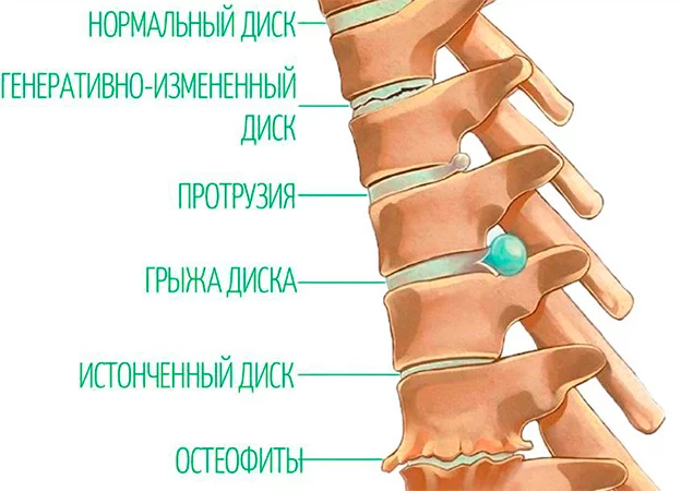 Остеохондроз грудного отдела позвоночника | Справочник КЛРЦ