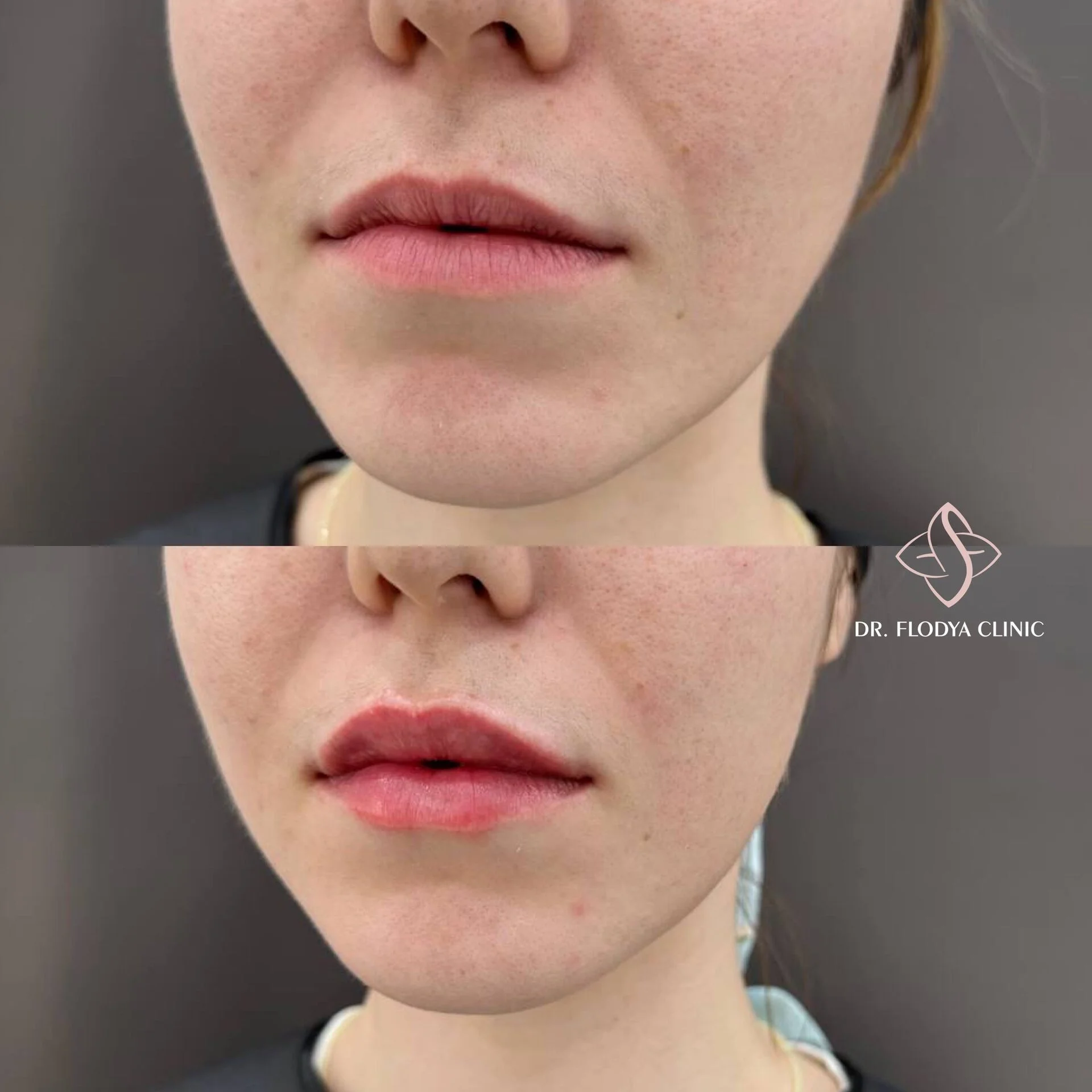 Естественный объём губ до и после — DR. FLODYA CLINIC