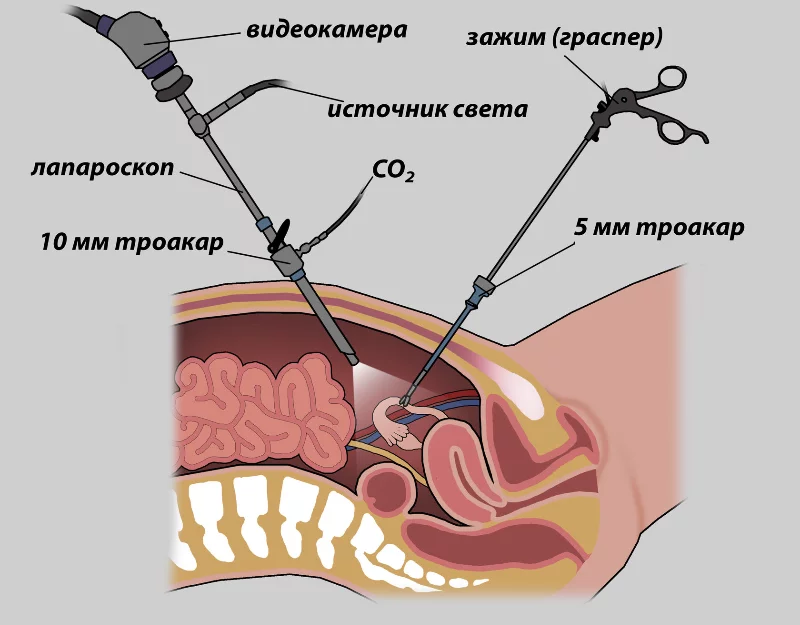 Спайки в кишечнике