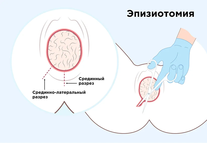 УЗИ при беременности | ТС Клиника — г. Краснодар Вагинальные папилломы