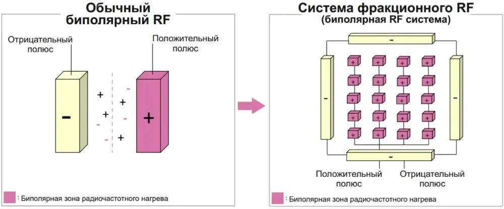Сравнение обычного монополярного RF и термической RF-системы NTTS