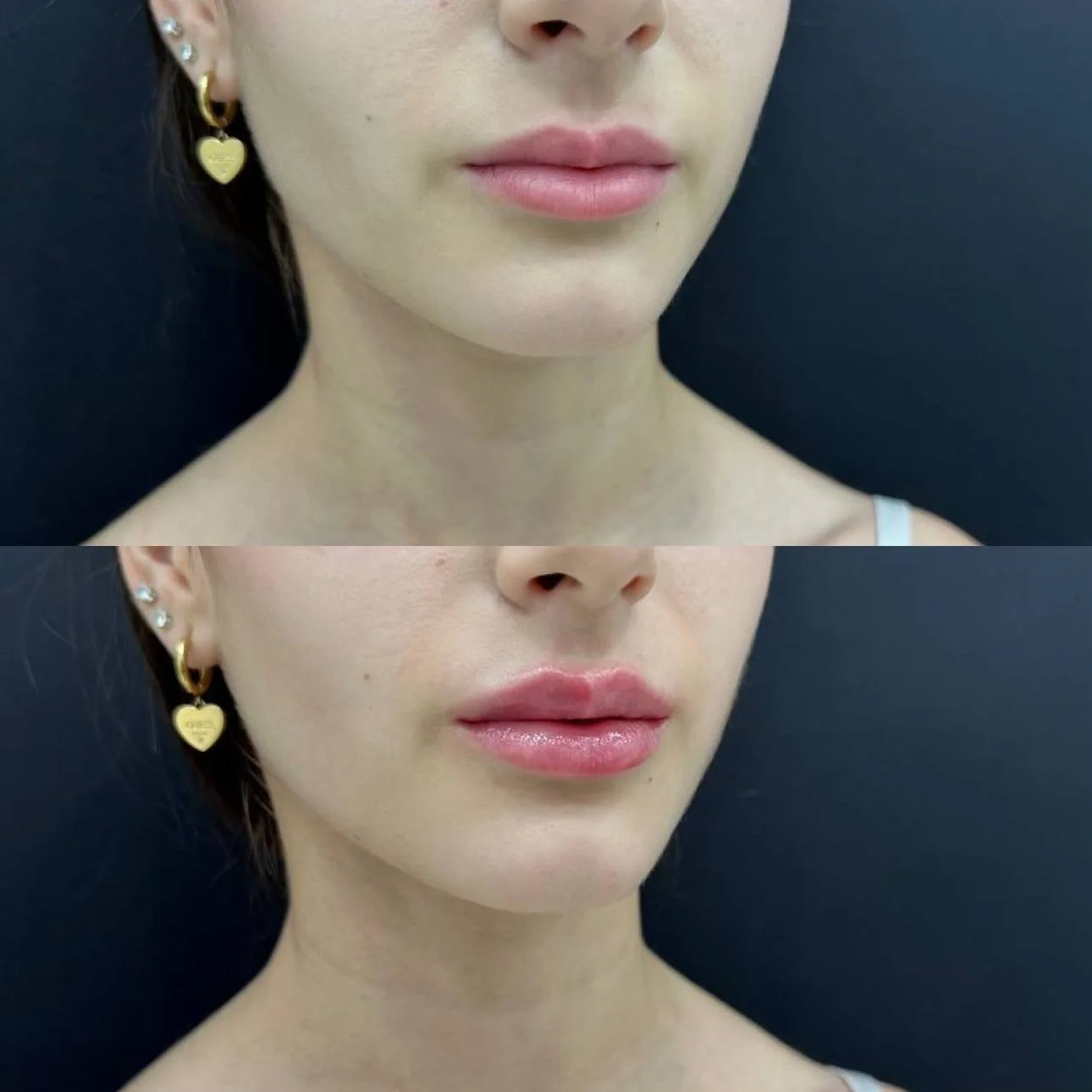 Увеличение губ до и после — DR. FLODYA CLINIC