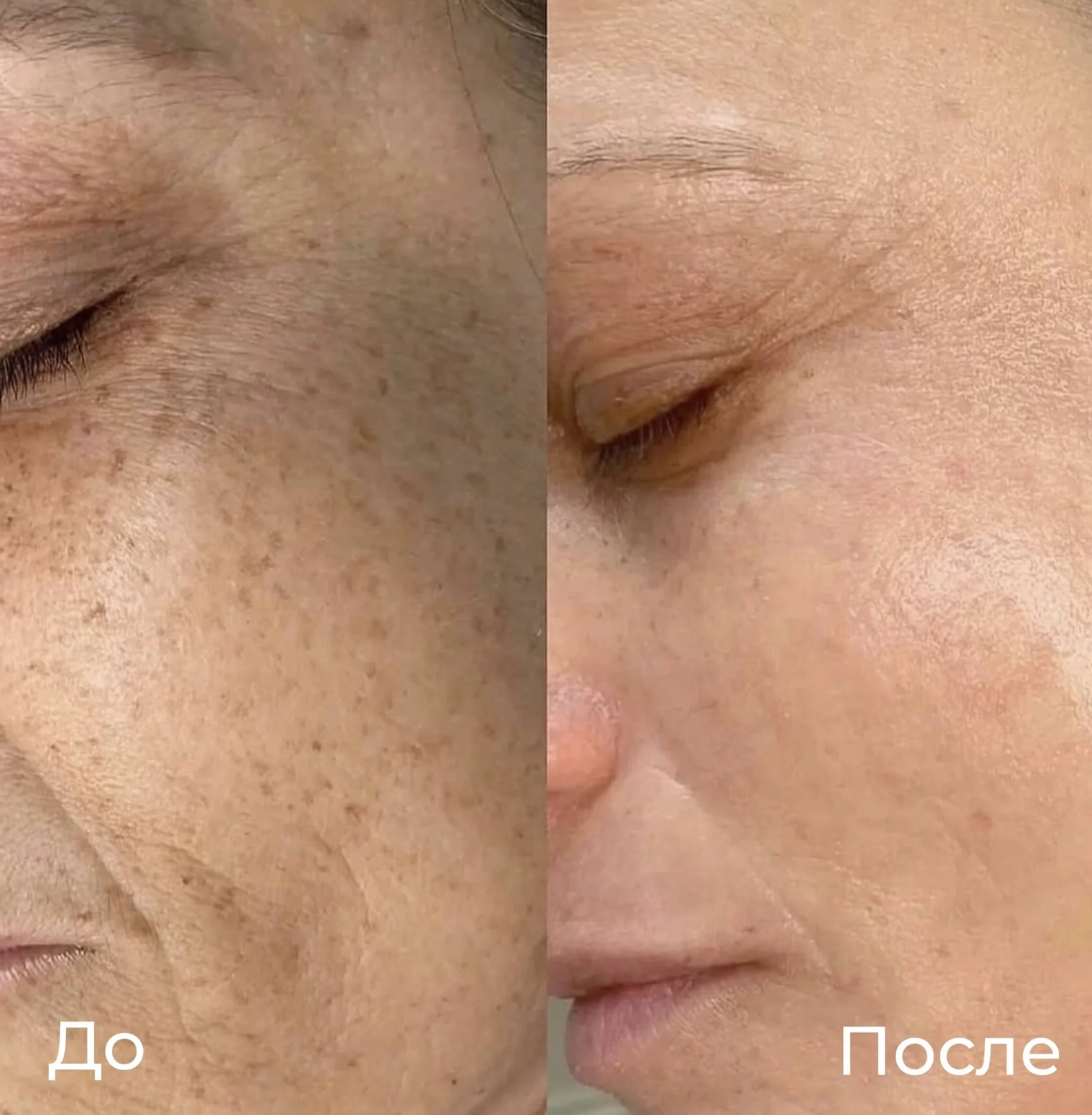 Фотоомоложение (IPL)