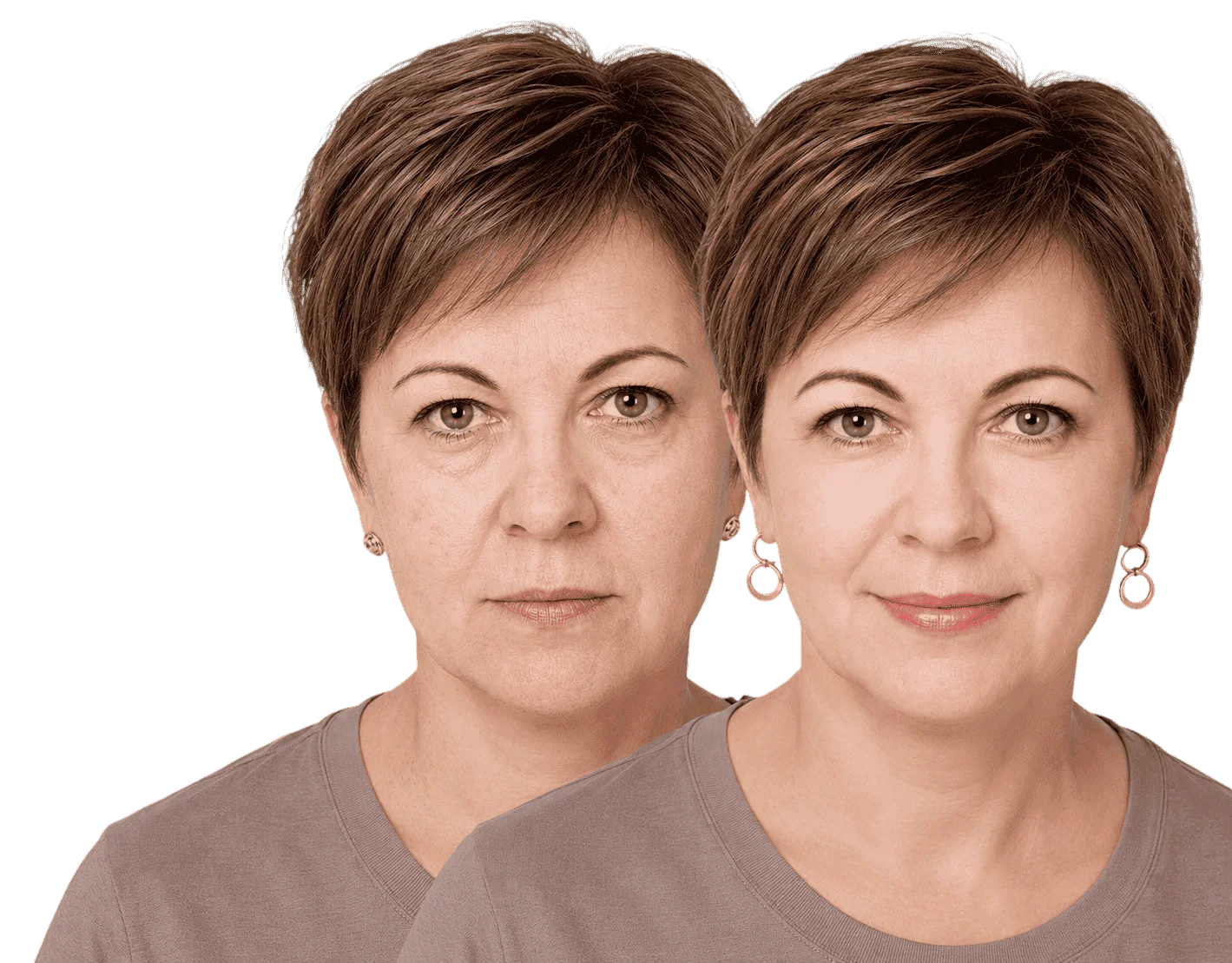Процедура RF-лифтинга лица
