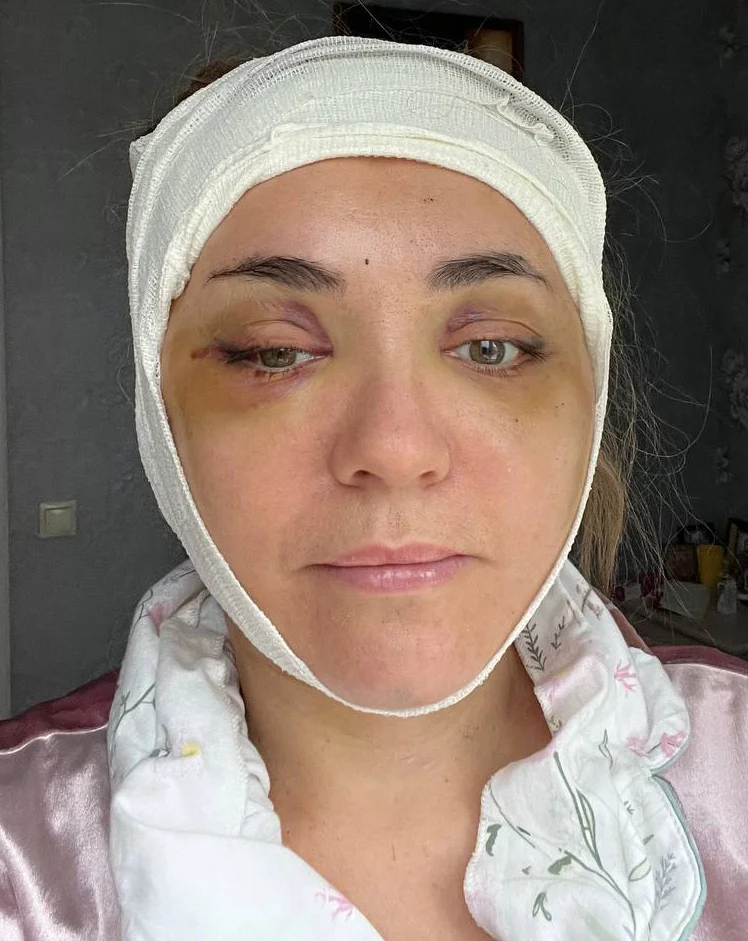 Реабилитация после смас лифтинга по дням