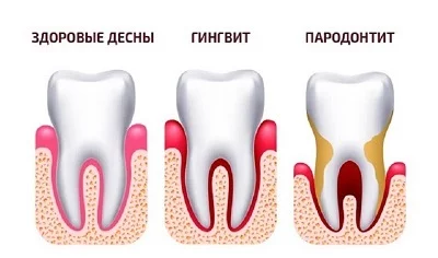 Чем лечить гингивит у детей. Причины и симптомы детского гингивита