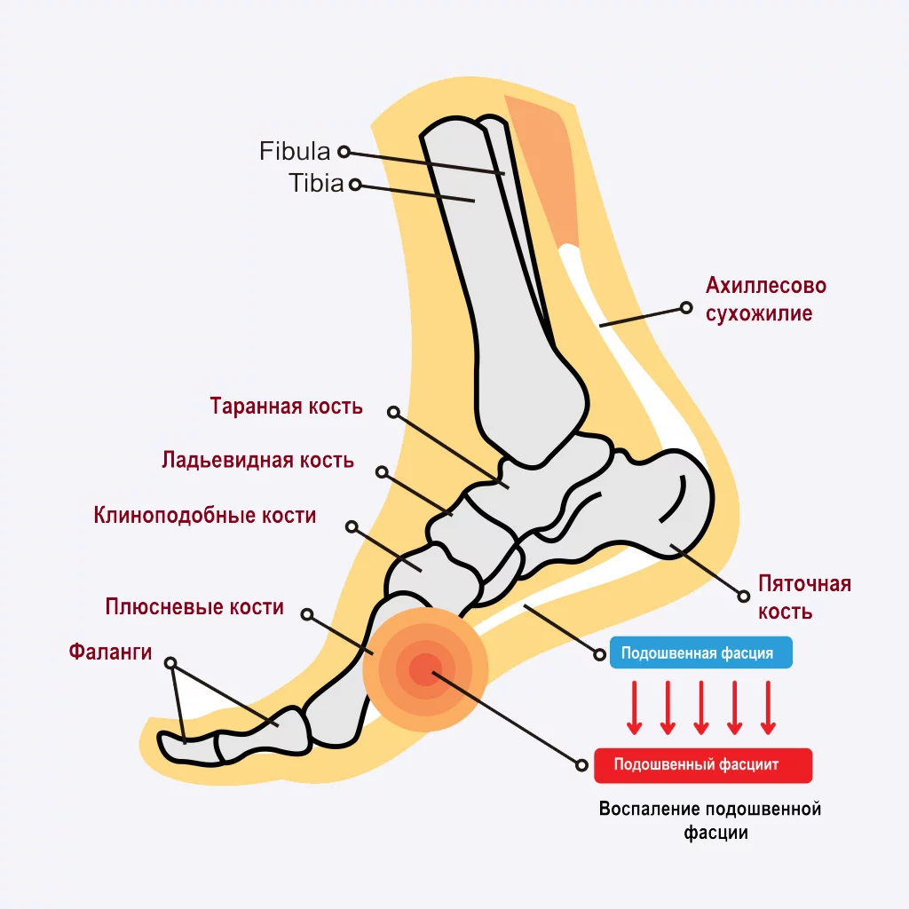 Как тейпирование помогает при плантарном фасциите?