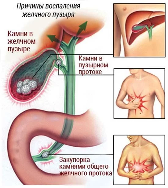 Камни в желчном пузыре: симптомы, диагностика, операция по удалению