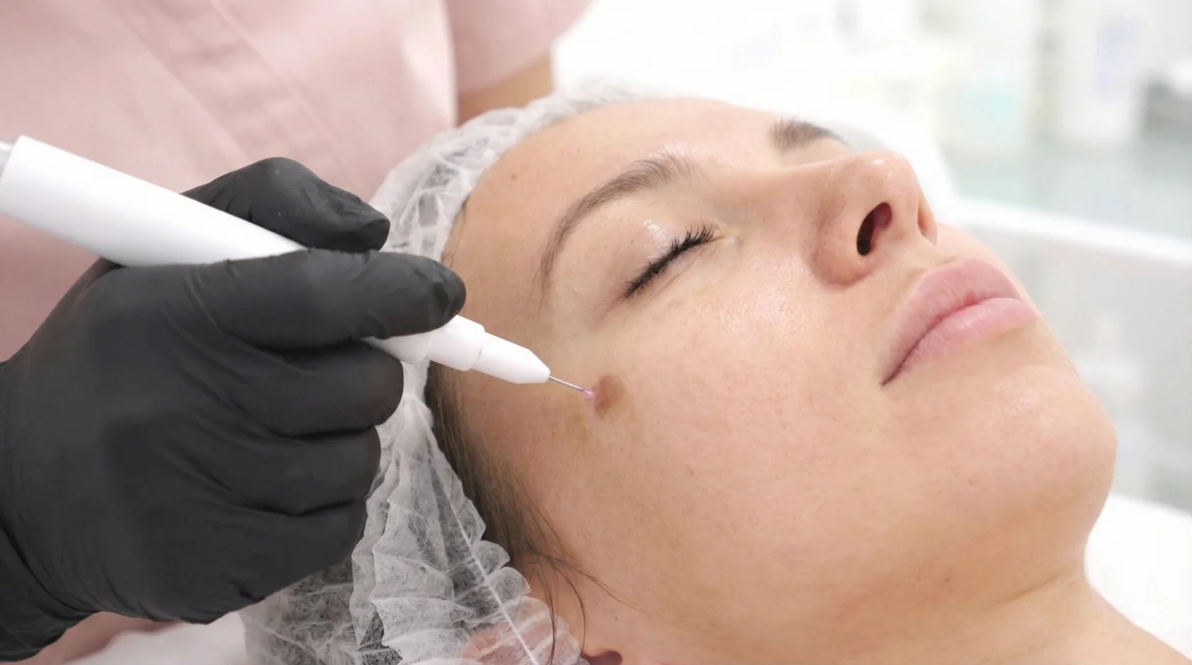 Удаление пигментации холодной плазмой в клинике БЬОРК