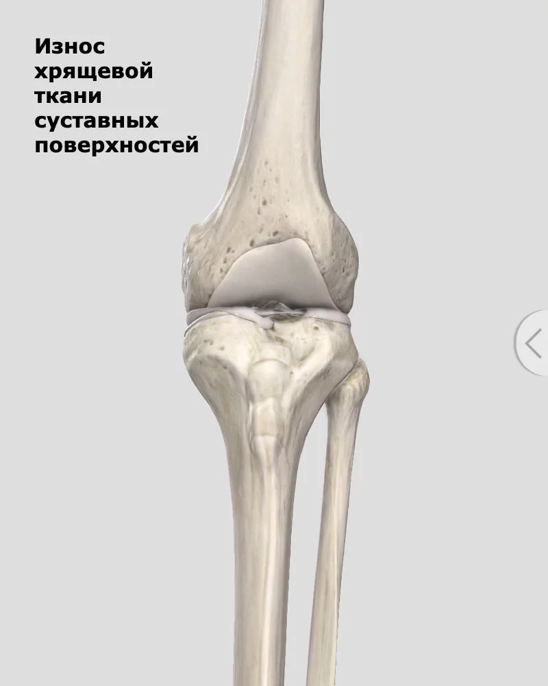 Что такое артроз коленного сустава лечение и симптомы, как лечить артроз  колена | MioClinic