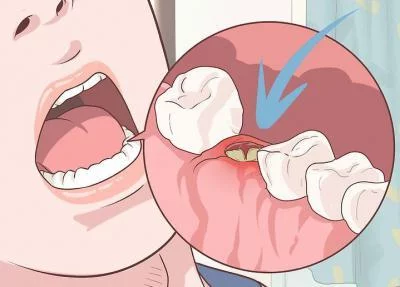 Зубная боль при грудном вскармливании: чем можно обезболить