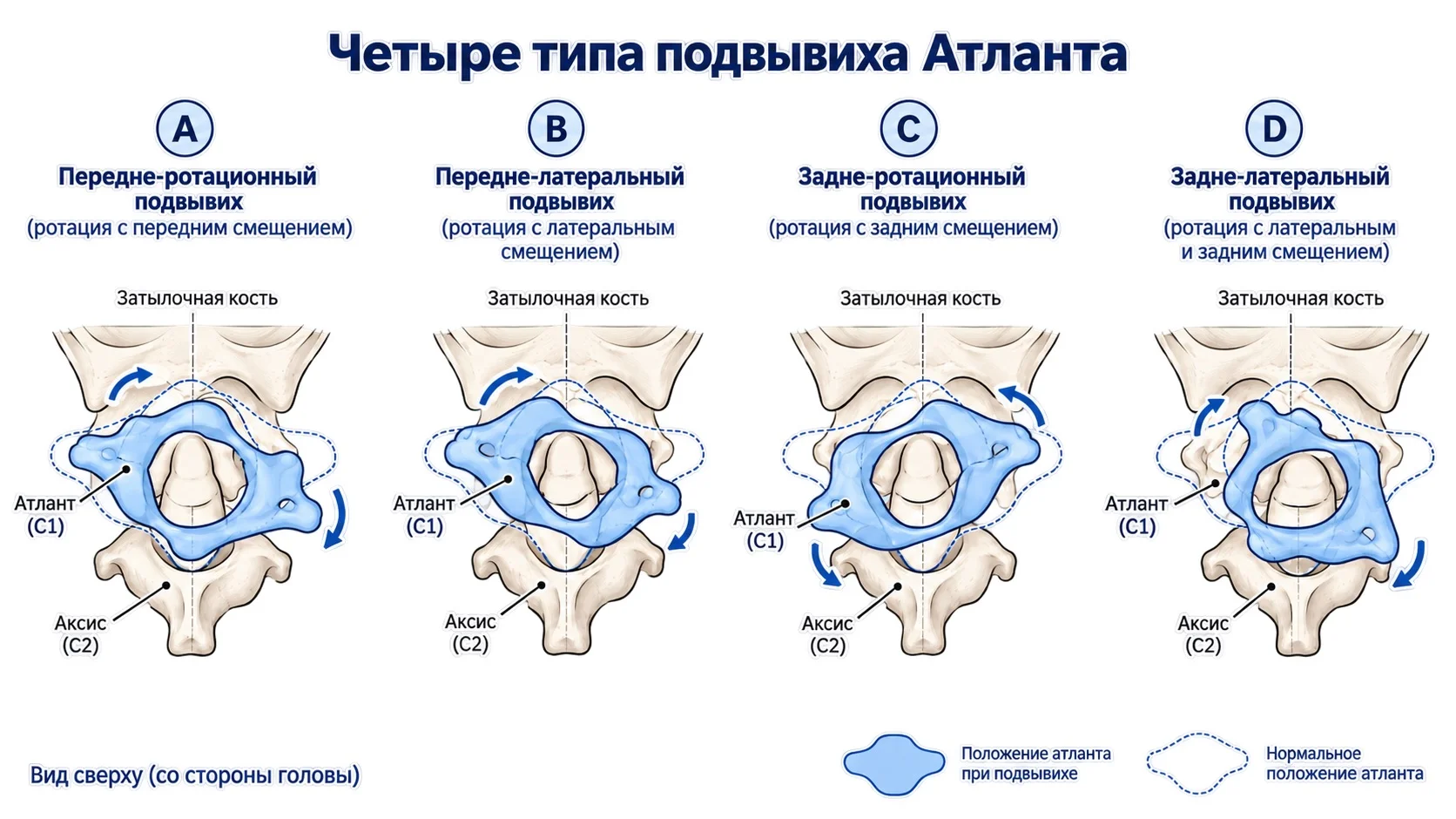 Четыре типа подвывиха Атланта C1 — схема ротационных и латеральных смещений первого шейного позвонка