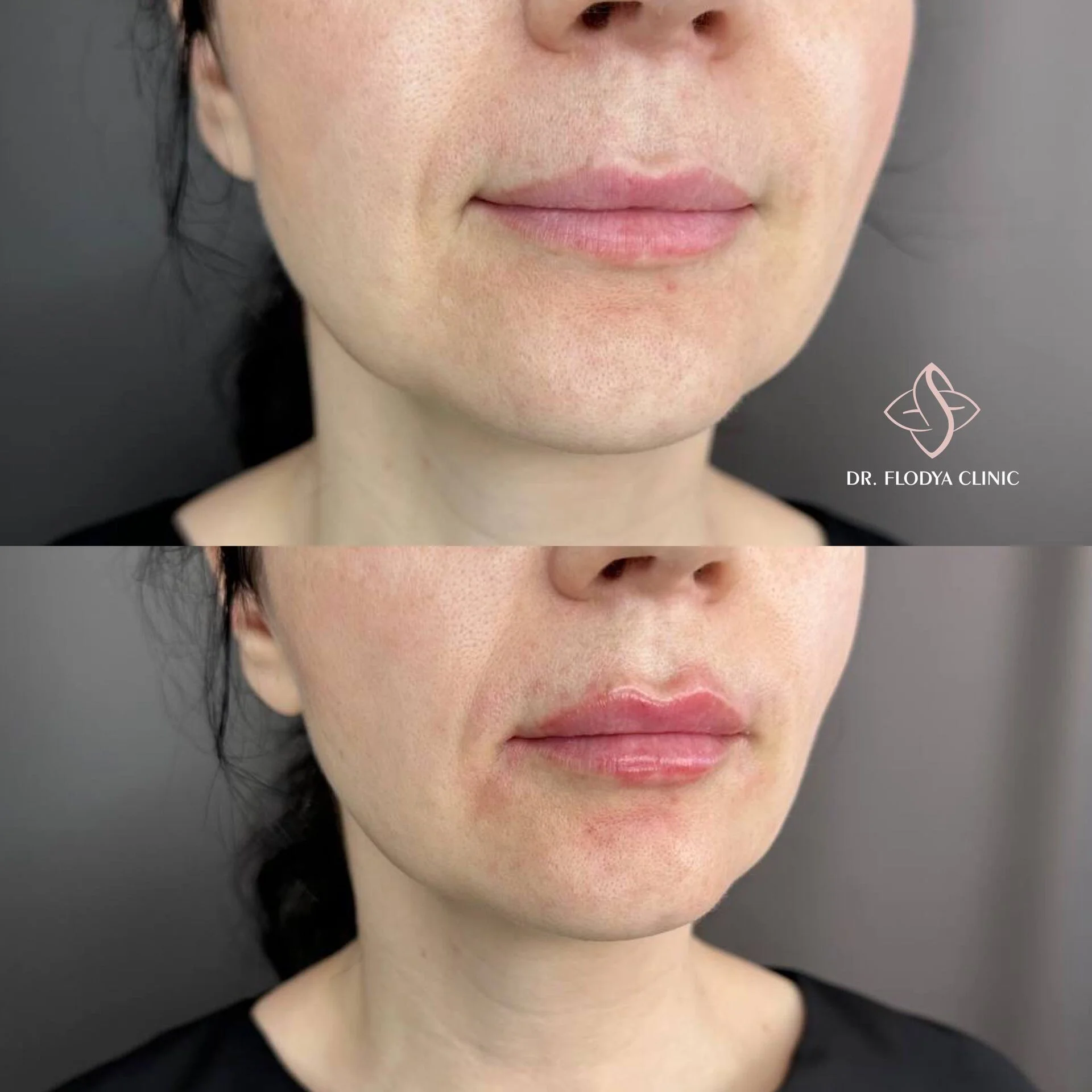 Контурная пластика губ до и после — DR. FLODYA CLINIC