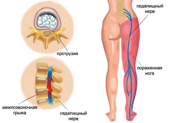 Как сделать укол самому себе в бедро: пошаговая инструкция