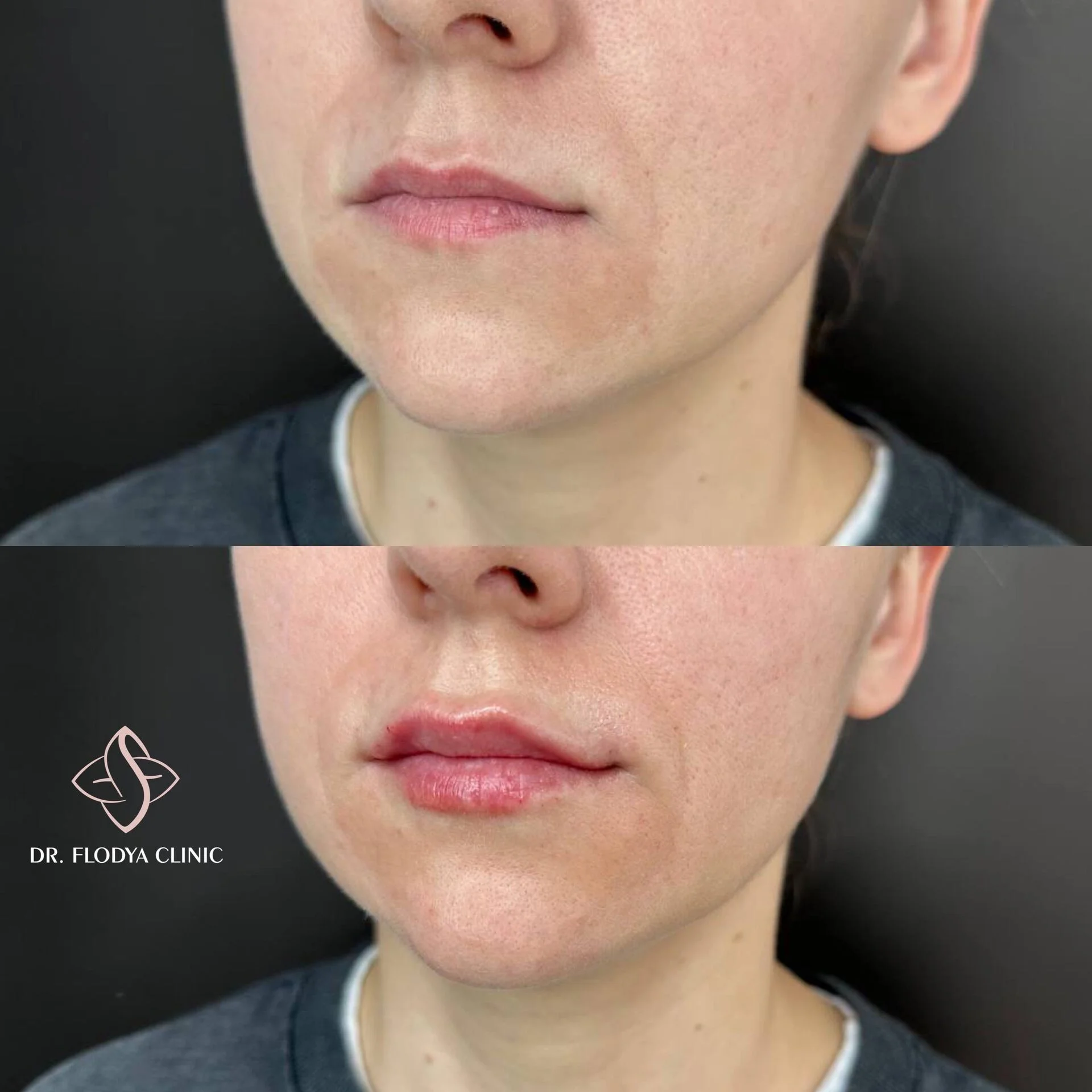 Контурная пластика губ до и после — DR. FLODYA CLINIC