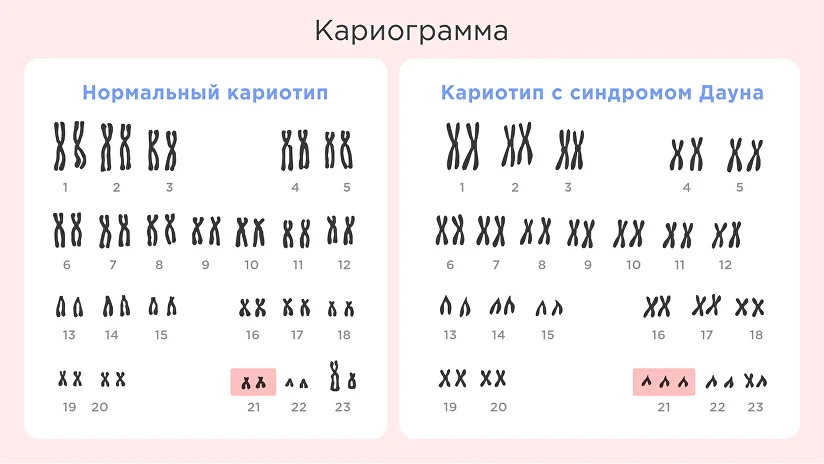 Люди с синдромом Дауна: особенные и обычные | Ozon Забота | Дзен