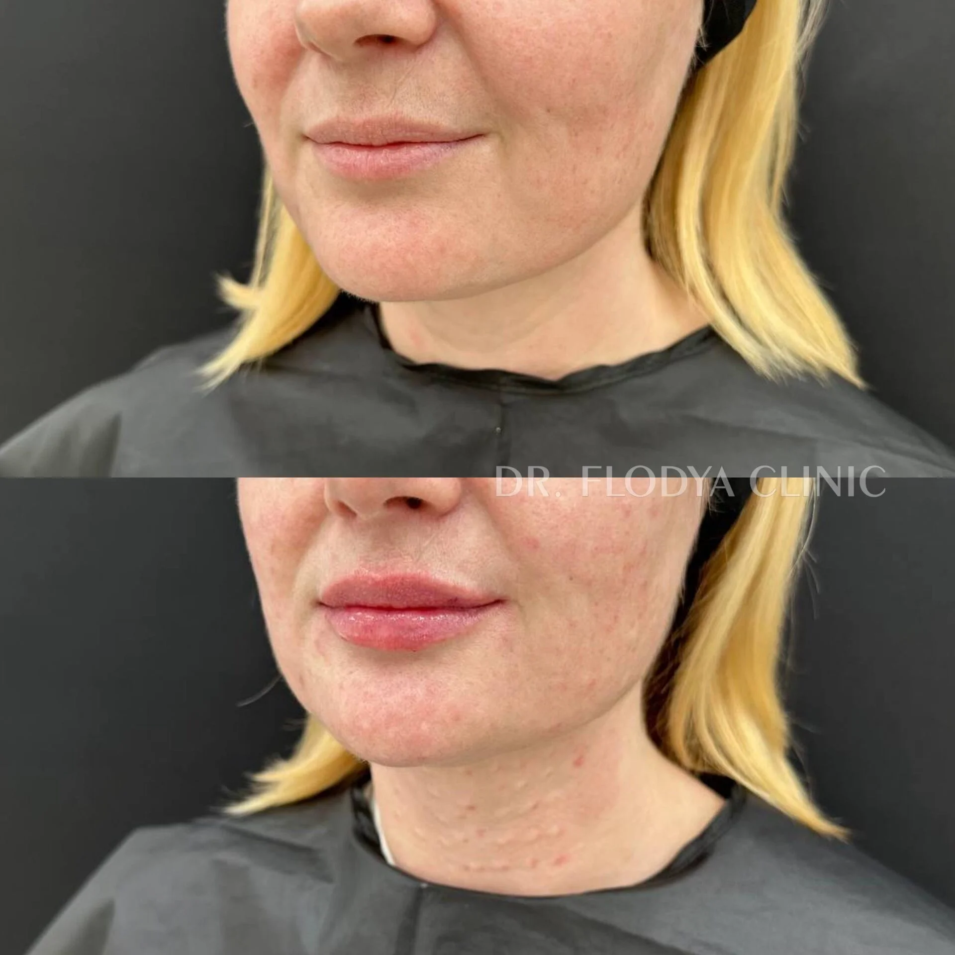 Контурная пластика губ до и после — DR. FLODYA CLINIC
