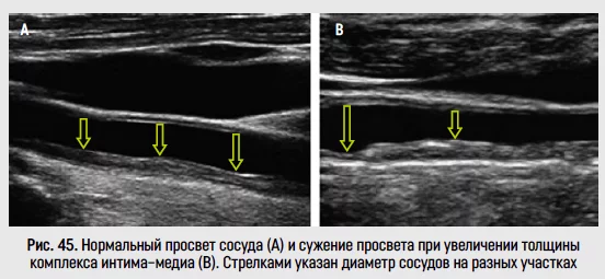 Ультразвуковое измерение толщины комплекса интима-медиа (ТИМ - IMT) | Медцентр им. Рабина, Израиль