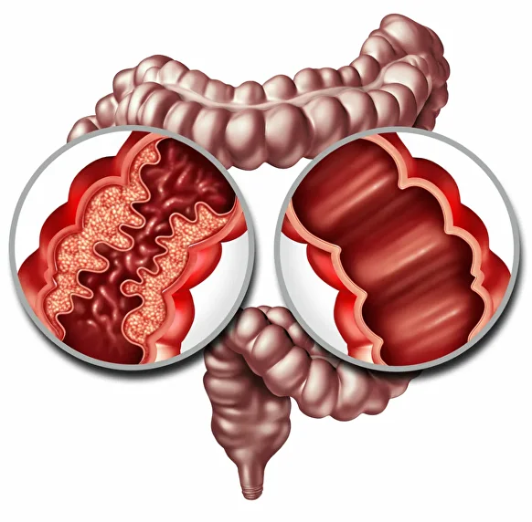 Treatment of colon cancer at OncoCareClinic 308