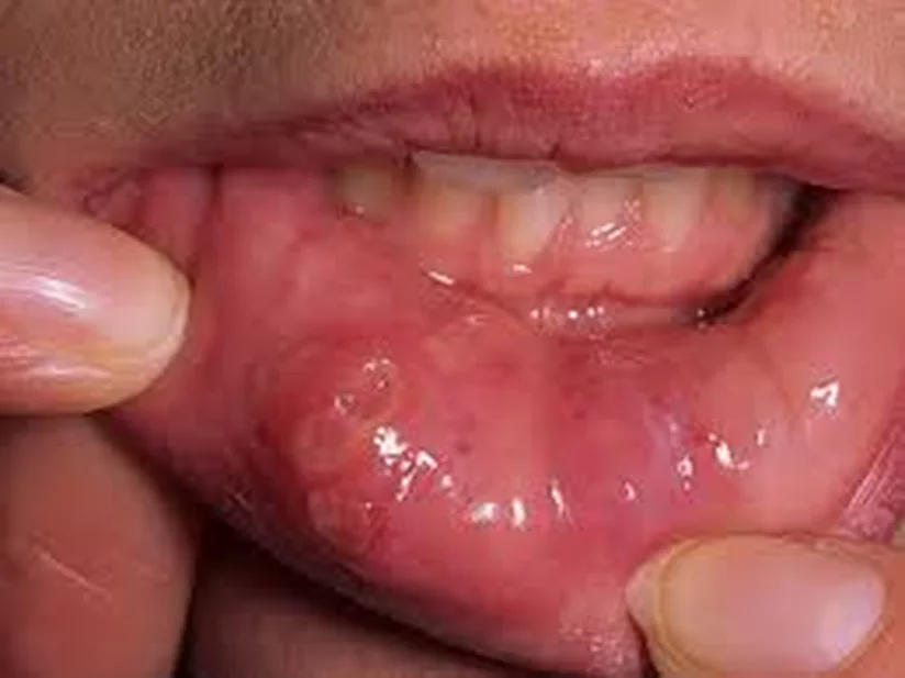 Стоматит и другие воспаления слизистой полости рта у взрослых | Colgate®