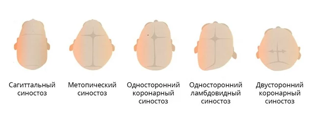 Плагиоцефалия у детей