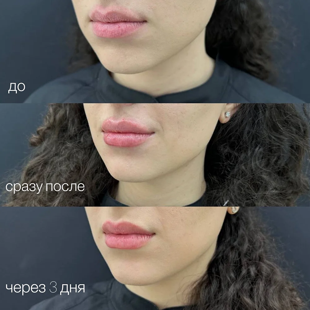 Контурная пластика губ до и после — до, сразу после и через 3 дня, DR. FLODYA CLINIC