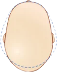 Долихоцефалия