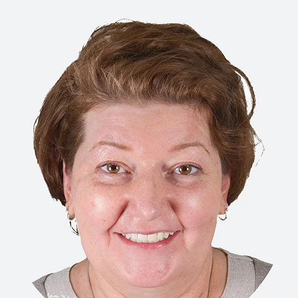 Елена после лечения: брекеты, виниры и имплантация