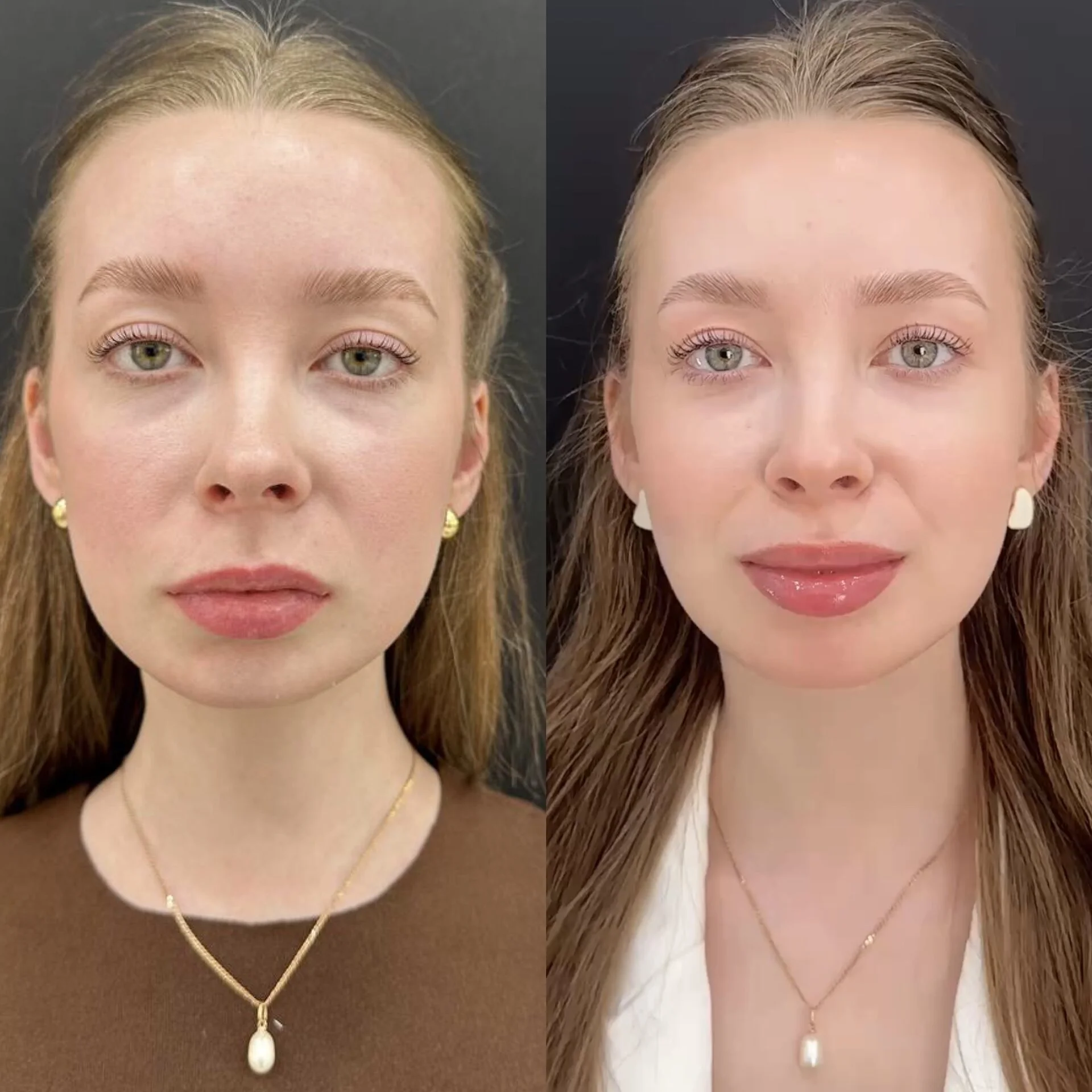 Контурная пластика губ до и после — DR. FLODYA CLINIC, Краснодар