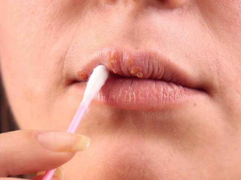 Как лечить простуду на губах: простой герпес