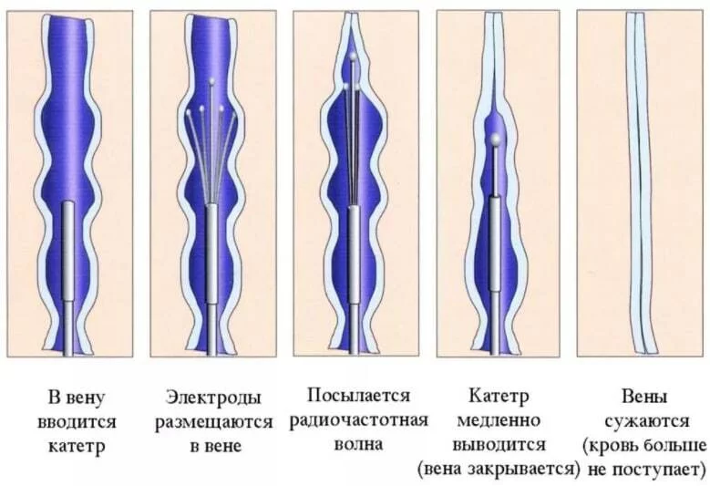 Сосудистая сетка на ногах